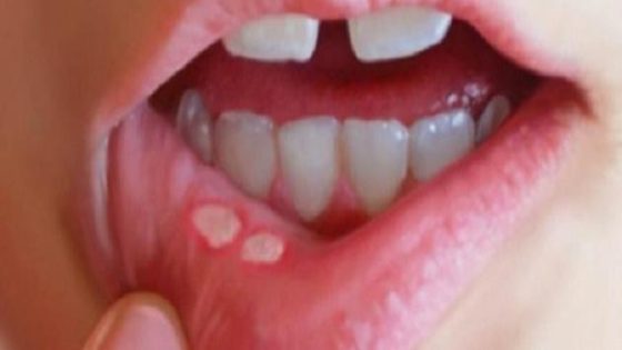 كيفية علاج فطريات الفم عند الأطفال